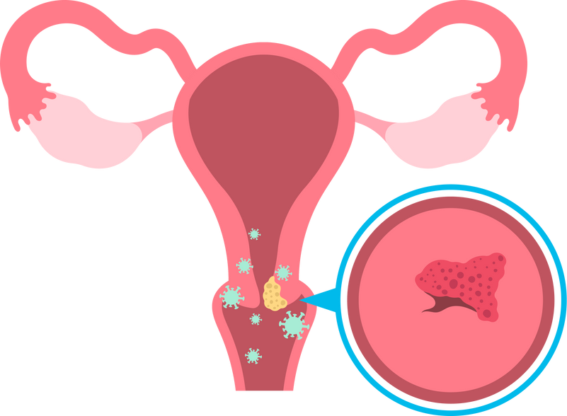 vaginal exam examine cell herpes dysplasia women female test