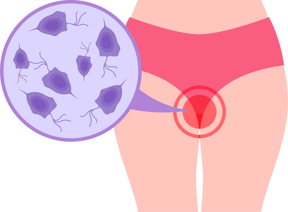 trichomonas vaginal trichomoniasis discharge Bacterial vaginosis HPV virus candidiasis Transmitted Disease Chlamydia Gonorrhea  vagina cancer odor bacteria pain cervix yeast Itching warts